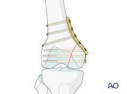 Check spelling or type a new query. Orif Lag Screws With Or Without Buttress Plate For Partial Articular Fracture Medial Condyle Sagittal Simple