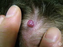 Image result for Pyogenic Granuloma