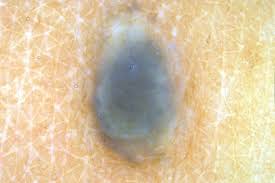 Image result for Blue Nevus