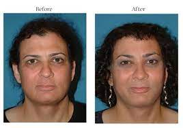 While some trans women may choose to undergo sexual reassignment surgery (srs), others may find that hormone consider face feminization surgery. Male To Female Feminization Plastic Surgeon Palo Alto California