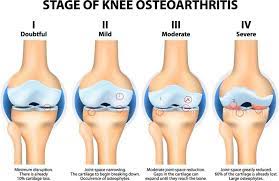 Clinically proven arthritis remedy eases knee pain in 2 weeks. Knee Osteoarthritis Sun Orthopaedic