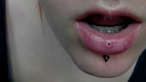 Vertical Labret Hole Scar Tissue I Don T Have This Piercing Anymore Youtube