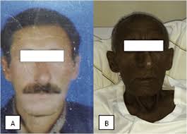 Image result for Diffuse Hyperpigmentation