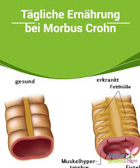Tagliche Ernahrung Bei Morbus Crohn Besser Gesund Leben Gesundheit Morbus Crohn Besser Gesund Leben