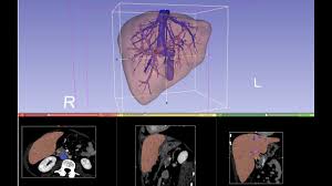 Popular liver 3d models view all. Organ Segmentation 4 2 Liver Vessels Youtube