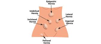 Inguinal Hernia Orange County Hemorrhoid Clinic