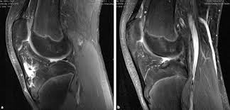 Klinik Bildgebung Und Therapie Des Morbus Osgood Schlatter Springerlink
