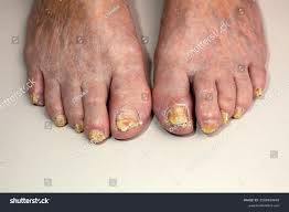 Image result for Onycholysis feet