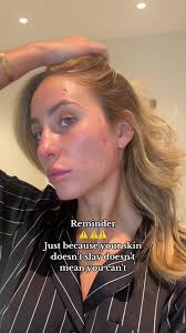 Dont let your skin stop you from feeling confident! #acne