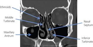 Image result for Sinus CT