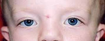 Potocki Lupski Syndrome Medlineplus Genetics