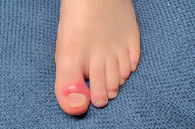 Image result for Toenail Removal
