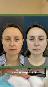 Результат комплексної роботи з пігментацією 👌🏻, Якщо Вас турбує  нерівномірний тон обличчя,виражена пігметація та почервоніння- запрошуємо  до нас 😉 лікарі клініки проведуть консультацію,складуть план ...