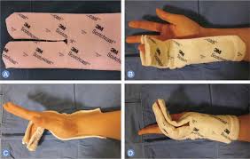 Image result for Ulnar Gutter Splint