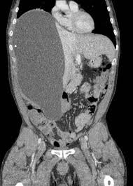 Final Diagnosis Right Subphrenic Intraperitonal Encapsulated Csf Csf Pseudocyst Collection Containing The Distal Ventriculoperitoneal Catheter Abdominal Cysts