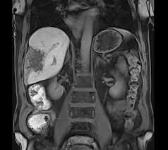 Haematological malignancy in the western radiology plays an important role in staging, monitoring. Seronegative Alveolar Echinococcosis In A Patient With Multiple Myeloma International Journal Of Infectious Diseases