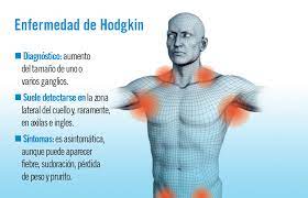El linfoma es un tipo de cáncer del sistema linfático, que es parte de la red del organismo que combate los gérmenes. Linfoma De Hodgkin Diagnostico Y Tratamiento