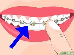 3 Ways To Avoid Getting Canker Sores - Wikihow