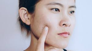 Acne myths - Beauty and personal care | CHOICE