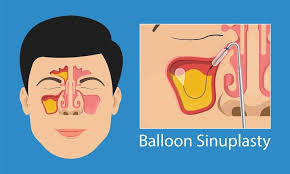 Image result for Sinus Surgery