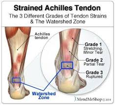 Achilles Tendinitis Common Causes Symptoms And Exercises Achilles Tendonitis Achilles Tendonitis Treatment Achilles