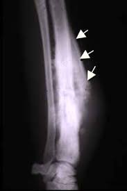Image result for Ewing Sarcoma