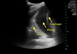 Image result for Parapneumonic Effusion