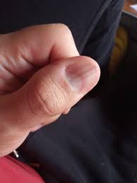Rayas Negras En La Una Pulgar De La Mano Izquierda