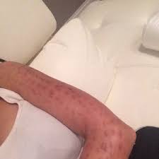 Thus, burns are among the most common side effects after laser hair removal. Will These Laser Hair Removal Burns Go Away Photos