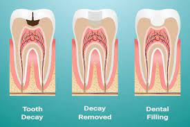 It will gradually break and fall out with time. Signs You Need A Tooth Filling Buckhead Cosmetic Family Dentistrybuckhead Dentistry
