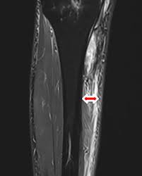 Ein blutgerinnsel hingegen ist etwas anderes, nämlich geronnenes, also „zusammenklebendes. Finde Heraus Ob Dein Bluterguss Nach Knie Op Harmlos Ist Oder Nicht Knie Marathon Knie Op Reha Patienten Aufgepasst