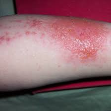 Image result for allergy rash on the legs