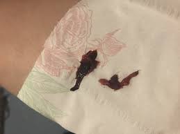 Not all miscarriages are physically painful, but most people have cramping. Does This Look Like An Early Miscarriage Would Be 4w5d