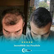 Quanto costa il trapianto di capelli in italia? Costo Trapianto Capelli Turchia Pacchetto All Inclusive