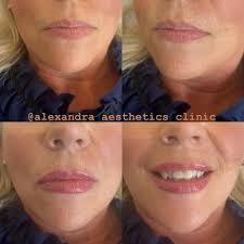 📩 FEBRUARY 15th Girlies! I have limited appointments available! 👄 Russian  Models needed x 6 £65 each (normally £125) * You must have very little to  no filler for this! @blushandblowsalon 🎥