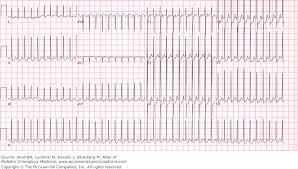 Pin On 12 Lead Ekg