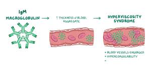 Image result for Hyperviscosity Syndrome