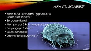 Apa yang penting adalah melindungi keluarga anda daripada kuman yang menyebabkan jangkitan. Cara Mengatasi Penyakit Kudis Buta Scabies Semudah Abc Nutrisi Guru