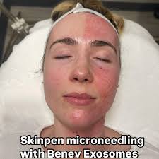SkinPen Microneedling with PRIMAzomes! Amazing benefits and results with  SkinPen treatments combined with Primazome Exosomes utilizing its tried and  true collagen remodeling technology and cell-to-cell communication! Truth  Serum applied after! #neowell ...