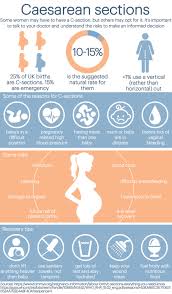 C Sections