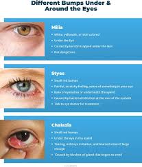Image result for milium cyst on eyelid