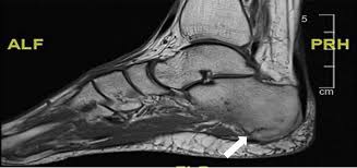 Image result for Calcaneus Compression Fracture
