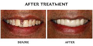 Patient Had Severe Gum Disease Which Led To Migration Of His Teeth And Development Of Spacing Between His Front Teeth Gum Disease Periodontal Disease Gum Care
