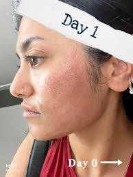 58 top Laser Scar Removal in Ghana ideas in 2025