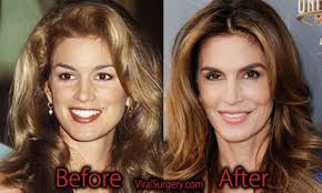 Cindy Crawford Plastic Surgery Before And After Cindycrawford Botox Plasticsurgery Actress Beauty Plastic Surgery Cindy Crawford Botox