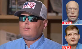 Face transplant survivor speaks about his new life six years after the  life-threatening surgery