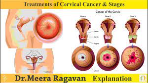 Treatment for advanced cervical cancer. Treatments Of Cervical Cancer Stages I Patient Education I Mic Youtube