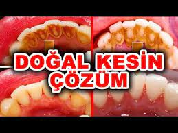 Diş taşı temizliği günlük rutin temizliklerle temizlenmezler. Dis Tasi Temizleme Nasil Yapilir Kesin Cozum Saglikli Gulusler Youtube