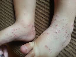 Image result for Atopic Dermatitis