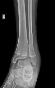 300 x 530 jpeg 55 кб. Lateral Malleolus Fracture Radiology Case Radiopaedia Org